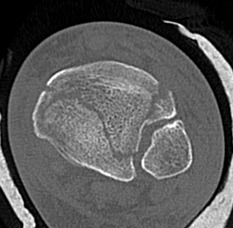 Syndesmotic equivalent fractures tibial plafond